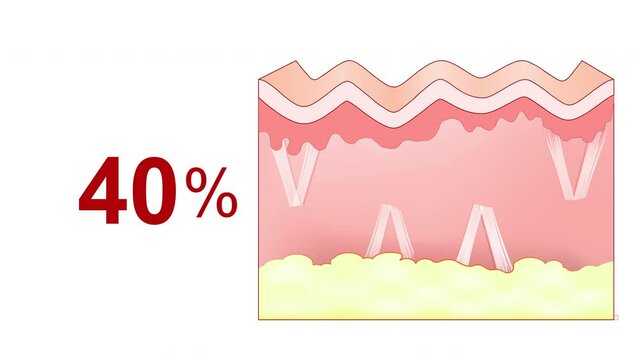 Aging process. Degradation of collagen fibers in the skin