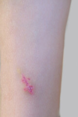 Healing scar, stitched wound on child's leg, wound healing process in child, surgical medical...
