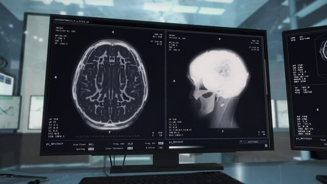 Using the x-ray technology for research of brain tumor growing in patients head. Conducting scientific brain tumor research. Brain tumor research examines the cancer cells of the growth.
