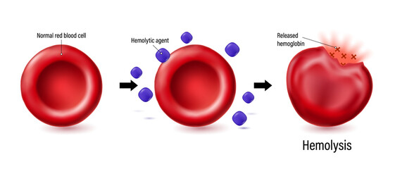 Hemolysis vector. The process of red blood cell destruction. Normal red blood cell with hemolytic agent and rupturing of erythrocyte. 