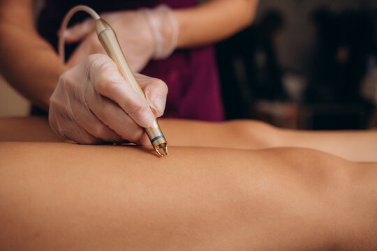 Varicose laser treatment on female legs in clinic