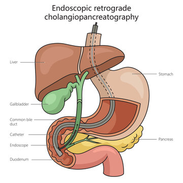 Endoscopic retrograde cholangiopancreatography structure vertebral column diagram hand drawn schematic vector illustration. Medical science educational illustration