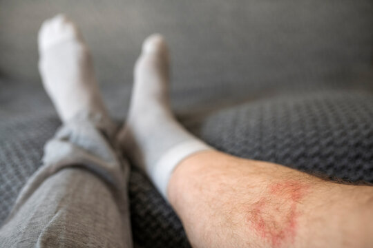 Low section of man with Lyme disease on leg at home
