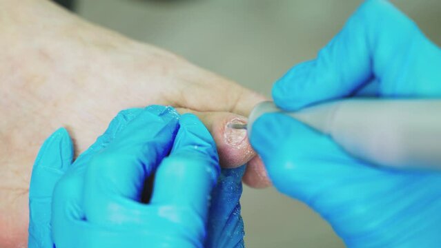 Treatment of toenails. An orthopedic doctor treats toenails for a fungal infection. Close-up.
