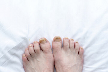 Male cut nails with nail fungus. Fungal infection on hands legs, finger with onychomycosis. Care...