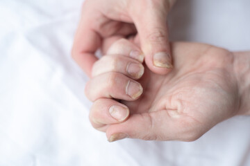 Male cut nails with nail fungus. Fungal infection on hands finger with onychomycosis. Care and treatment. Closeup of a foot with damaged nails because of fungus