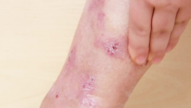 hand applies ointment to wounds, rash, hives, itchy skin on leg, inflammation, Medical Allergies, disease female patient, Dermatology Issues, skin problems on general physical and emotional well-being