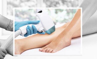 Elos epilation hair removal procedure on a woman’s body. Beautician doing laser rejuvenation on...