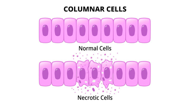 Columnar Cells - Normal Epithelial Cell - Necrotic Cell - Medical Vector Illustration