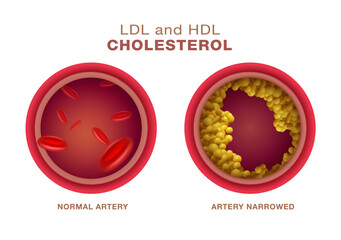 Types of comparison of atherosclerotic cholesterol with HDL and LDL lipoproteins. Cross section of normal and narrow arteries with clogged arteries. can cause high triglycerides. Vector illustration. - obrazy, fototapety, plakaty