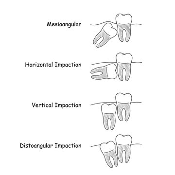 Dental anatomy set, incorrect teeth growth, set of vector illustrations in doodle style