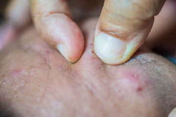 Picture of squeezing out acne bumps on the skin