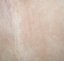 Picture of the problem of bumps and red rashes on the skin on the human body. - obrazy, fototapety, plakaty