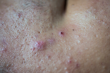 Fototapeta premium Picture of the problem of bumps and red rashes on the skin on the human body.