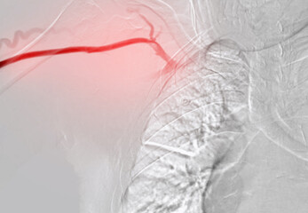 Balloon Angioplasty is a medical procedure used to widen narrowed or blocked blood vessels.