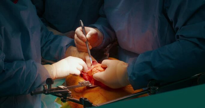 Closeup of cancer malignant tumour removal surgery from stomach area. Surgeons in scrubs and masks perform complicated surgery in operating theatre