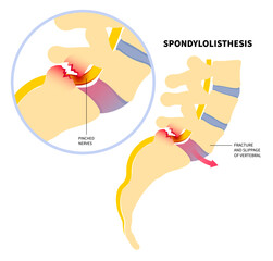 The Spondylolisthesis a spinal disease that causes one of lower vertebrae slip forward with hip bone disk pain in sports accident injury and epidural steroid injections to nerve for fusion leg - obrazy, fototapety, plakaty