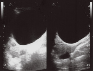full abdomen ultrasound sonogram - obrazy, fototapety, plakaty