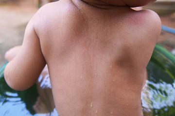 Toddler was bathing, his upper back was bitten by an insect. reddish color to the skin. mosquito...