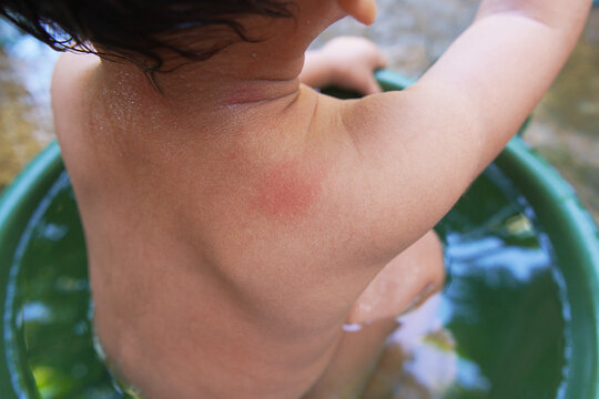 Toddler was bathing, his upper back was bitten by an insect. reddish color to the skin. mosquito bite marks
