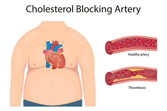 Atherosclerosis concept, health risk. Human heart. Medical vector illustration