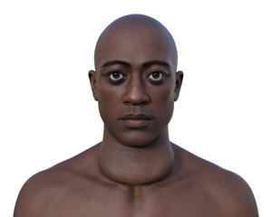 A man with enlarged thyroid gland, 3D illustration - obrazy, fototapety, plakaty