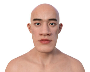 Fototapeta premium Acromegaly in a man, 3D illustration