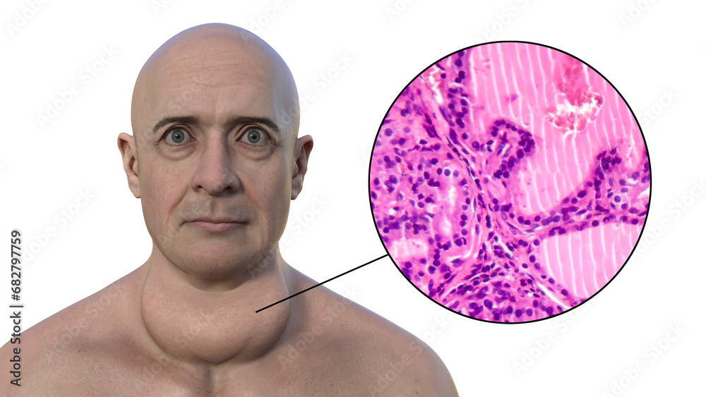 Canvas Prints A man with enlarged thyroid gland, 3D illustration, and micrograph toxic goiter