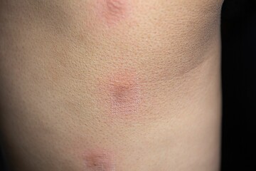 A photograph of marks after laser hair or scar removal from the skin. CO2 technique - obrazy, fototapety, plakaty