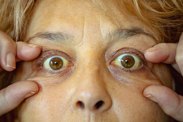 cancer patient. shot of the yellowish eyes. severe form of hepatitis. medical concept. life and...