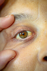 cancer patient. shot of the yellowish eyes. severe form of hepatitis. medical concept. life and...