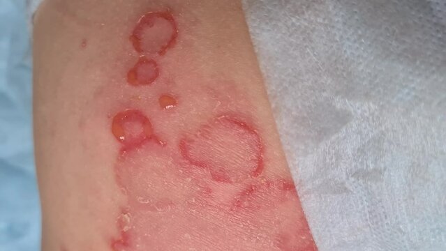 Large amount of red rash on child back and butt. Rash and pus and herpes on child buttocks