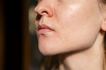 The woman skin flakes off at the mouth. Dry skin. Face skin irritation after peeling, after cold windy weather. Dark background, view by profile