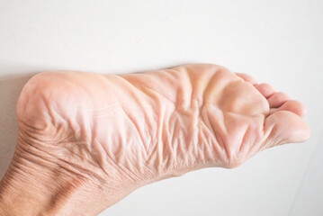 Image of the skin on the feet of an older person