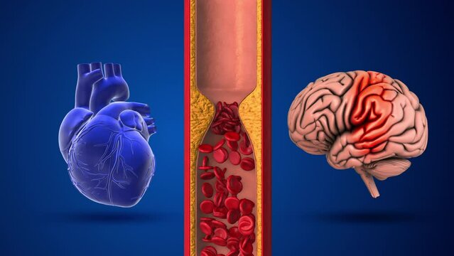 Difference between stroke and heart attack