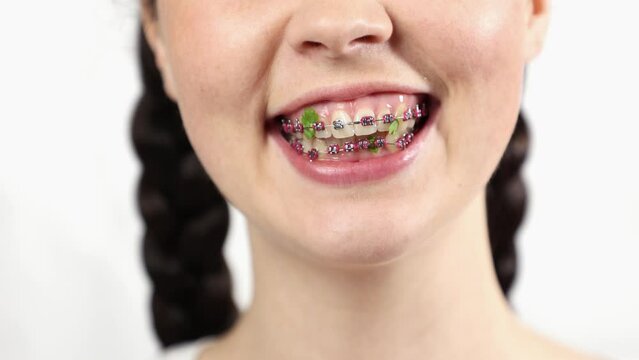 Close-up of young smiling Caucasian woman showing dirty teeth. Concept of orthodontic treatment and hygiene