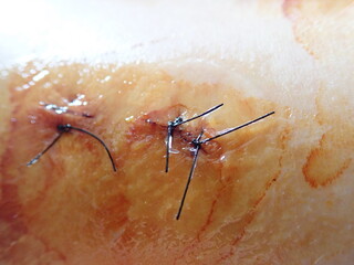 stitches on a scar on a knee