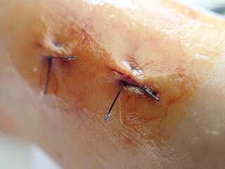 stitches on a scar on a knee