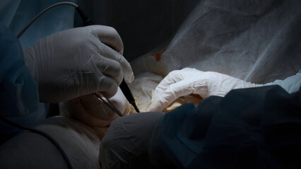 Cardiac surgeon and team perform median sternotomy. Action. Surgeon cauterizing and using...