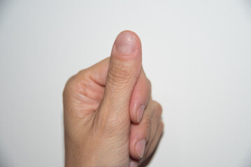 Obraz premium fingernail, dead root nail, onychogaphy, dermatology, fingernail