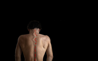 back of a man with a curved spine, scoliosis on a dark background.