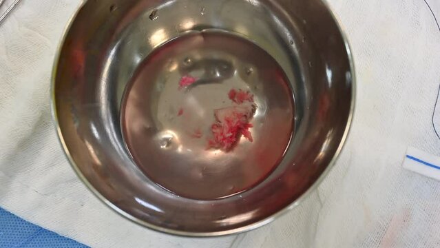 The appearance of herniated lumbar discs in a surgical bowl of water after herniated disc surgery