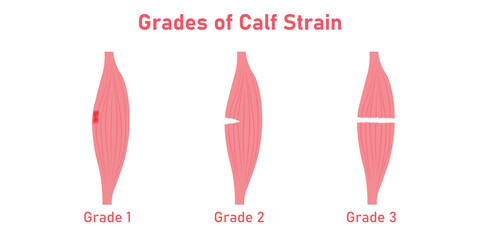 Three grades of calf strain diagram. Gastrocnemius strain. Scientific resources for teachers and students.
