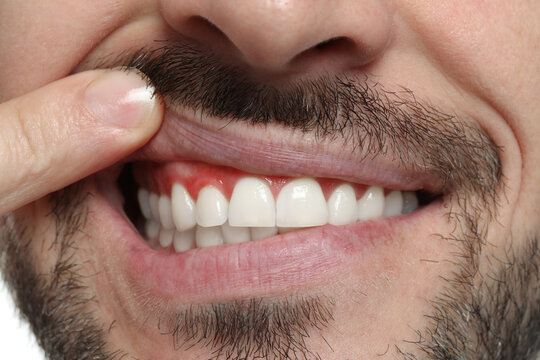 Man showing inflamed gum, closeup. Oral cavity health