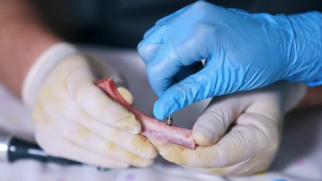 Hands in latex gloves hold a piece of bone. Hands in blue gloves attach rotating detail to a hole in bone. Close up.