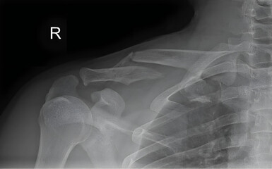 X-ray revealing a clavicle fracture, with clear delineation of the fractured bone segments.