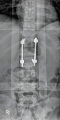 X-ray image showing lumbar spine fracture fixation