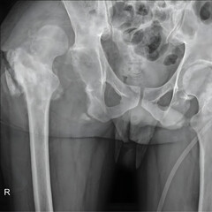 X-ray image revealing a hip joint dislocation, showcasing the displacement of the femoral head from its normal position within the acetabulum.