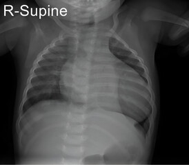 Pediatric chest X-ray revealing the thoracic anatomy of a child