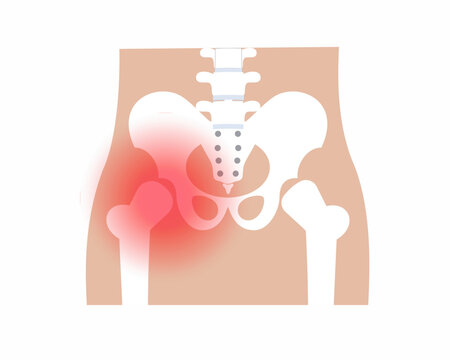 Pain in pelvic joint Arthritis pelvic joint pain syndrome pelvic Skeleton Bones Pain Injury and Inflammation vector illustration.